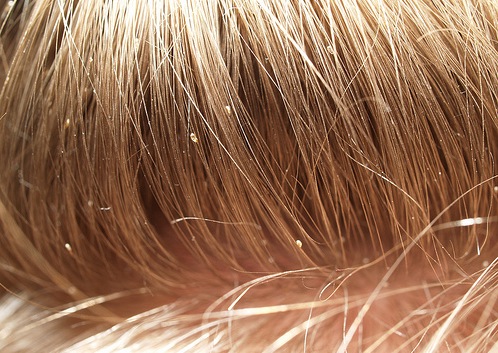 photo-of-nits-in-hair2